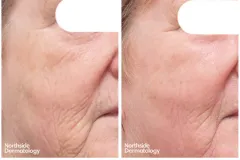 skin-resurfacing-CO2-before-and-after
