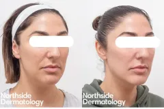 vascular-pigment-laser-before-and-after
