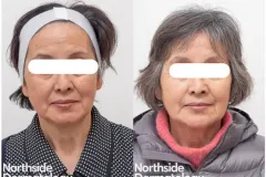 volume-loss-rejuvenation-before-and-after