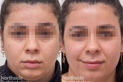 nanofractional-rf-acne-scar
