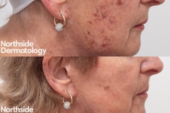 1.-B-and-A-after-1-treatment-with-1927nm-resurfacing