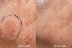 12-Co2-assisted-PDT-B-and-A-after-1-treatment