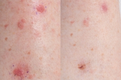 14-co2-assisted-PDT-for-skin-cancers-on-the-legs