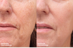 16co2-laser-resurfacing-for-sun-damage