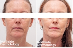 17-laser-resurfacing-for-sun-damage-2