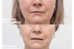 19Sun-damage-before-and-after-laserl-resurfacing