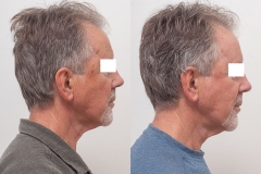 22PDT-and-laser-resurfacing-