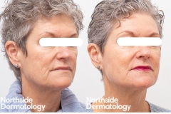 4-Hybrid-ablative-and-non-ablative-laser-for-sun-damage