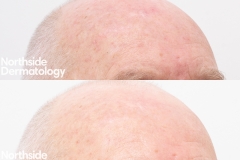 5.-sun-damage-and-following-laser-resurfacing