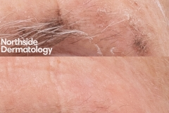 7-CO2-assisted-PDT-for-actinic-keratosis