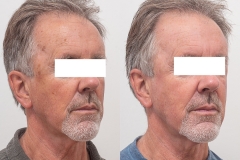 8-PDT-and-laseMD-for-sun-damage-b-and-A-after-1-treatment-please-mask-eyes