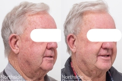 PDT photodynamic therapy adn vasccular laser for sun damage