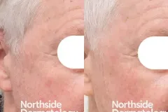 photodynamic therapy sun damage solar keratosis