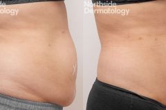 Left-side-2-months-post-trusculpt