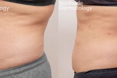 Right-side-2-months-post-trusculpt