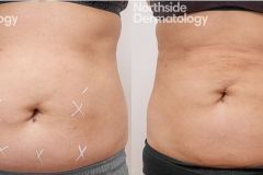 two-months-post-trusculpt-top