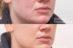 acne-red-scar-vascular-laser