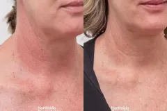 poikiloderma-vascular-laser-neck-redness