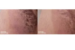 red-traumatic-scar-vascular-laser