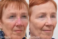 vascular-laser-for-facial-redness