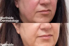 vascular-laser-face-rosacea-rejuvenation