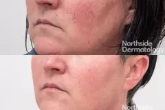 vascular-laser-facial-vein-reduction