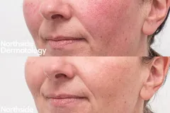 vascular-laser-for-redness-rosacea-face