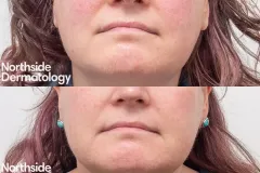 vascular-laser-rosacea-telangiectasia