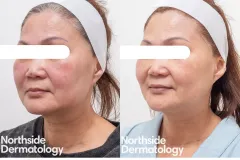 vascular-melasma-post-laser-genesis