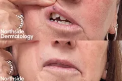venous-lake-lip-vascular-laser