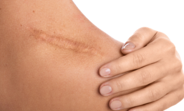 Scar Revision