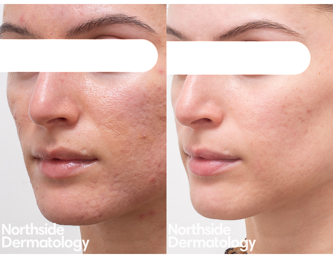 TCA Cross Treatment Melbourne Northside Dermatology TCA Cross Treatment Melbourne Northside Dermatology