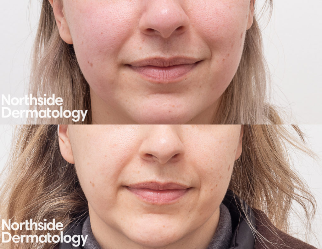 NanoFractional RF Melbourne Northside Dermatology