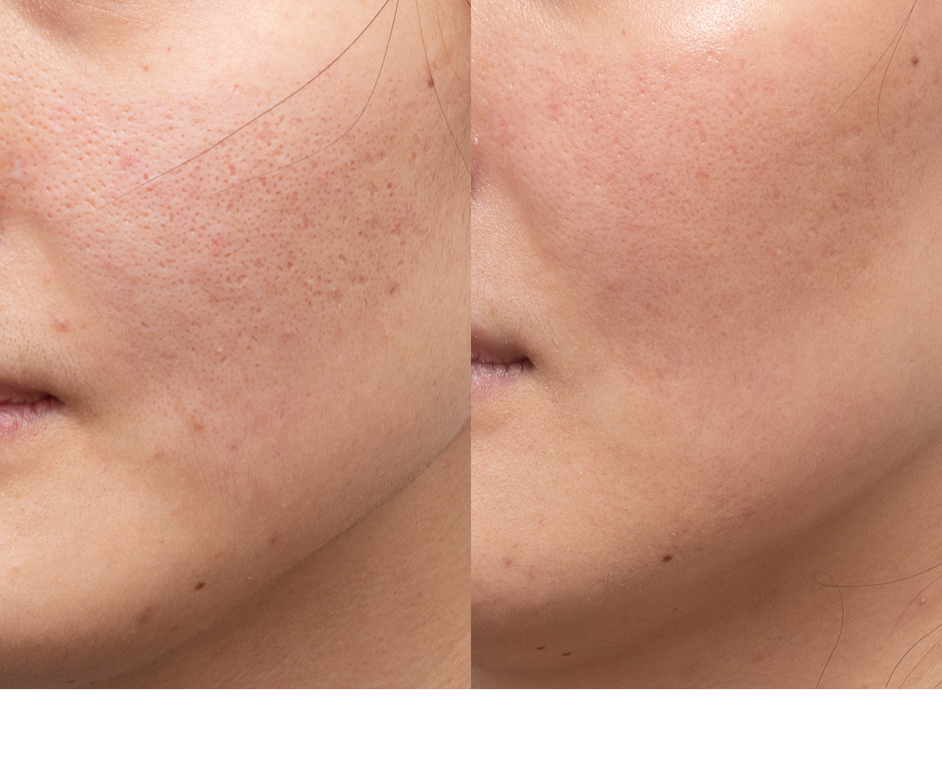TCA CROSS icepick acne scars by Melbourne Dermatologist