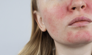 Redness Concern