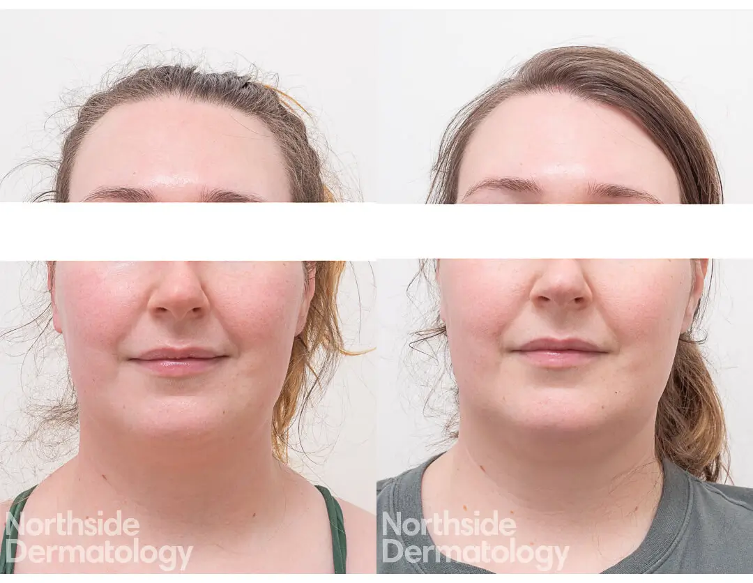 After: Smoother skin, reduced redness after Northside treatment.