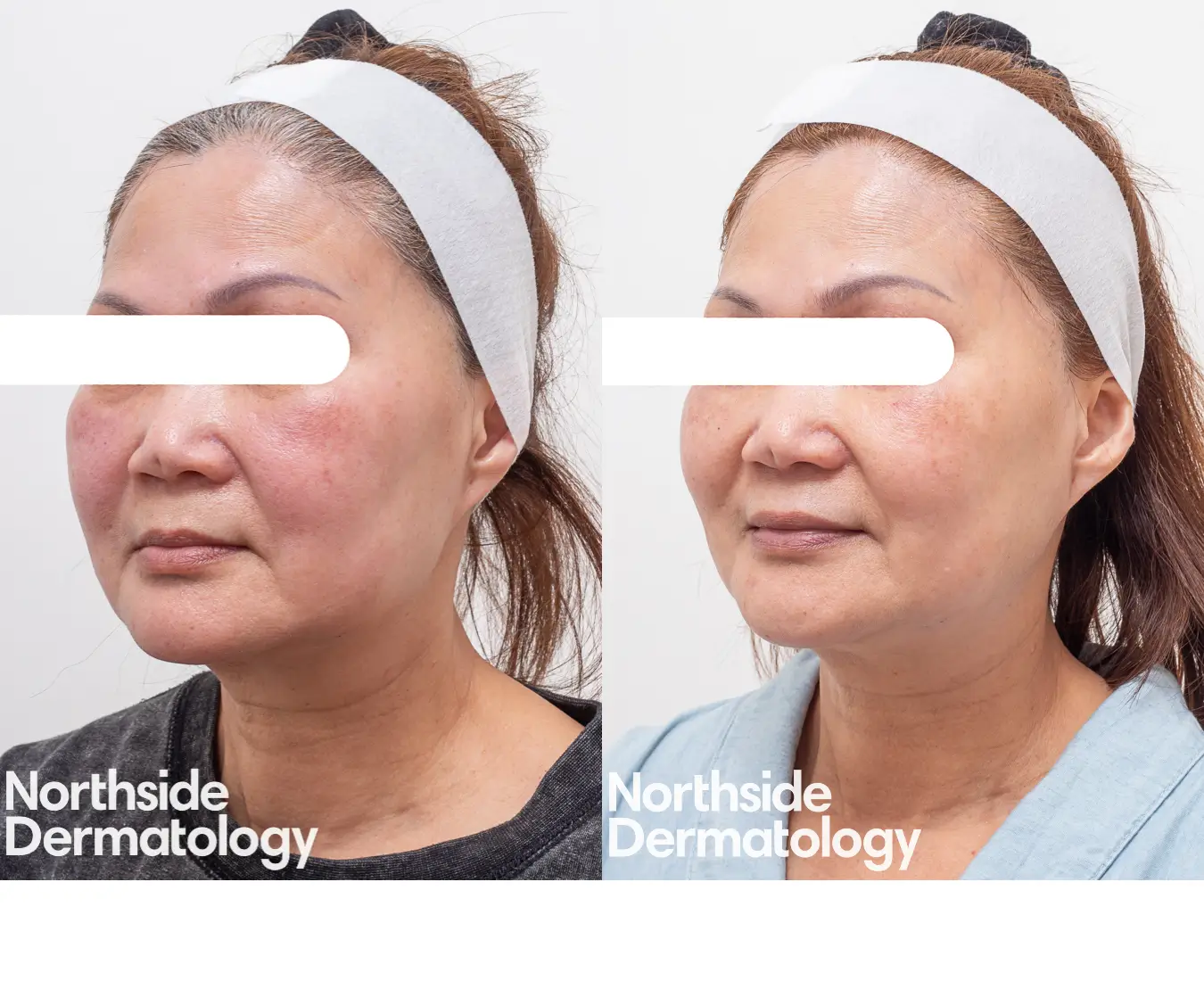 vascular-melasma-post-laser-genesis