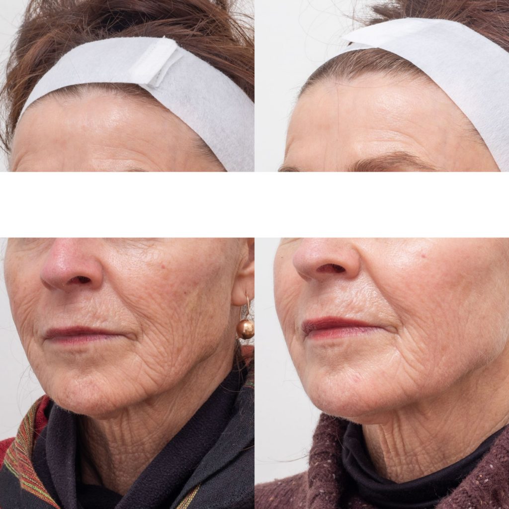 co2 and 1927nm ablative and non ablative laser resurfacing for wrinkles