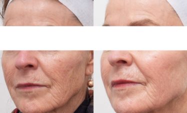 co2 and 1927nm ablative and non ablative laser resurfacing for wrinkles