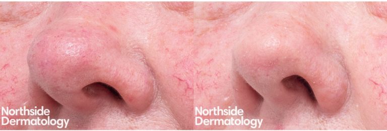CO2 Laser Resurfacing | Northside Dermatology