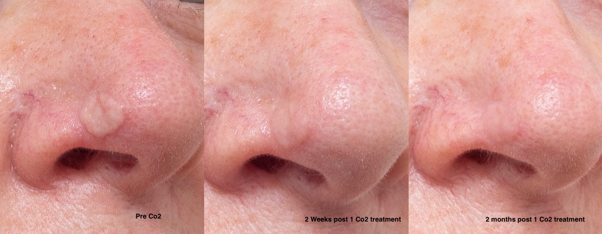 CO2 Laser Treatment Before & After