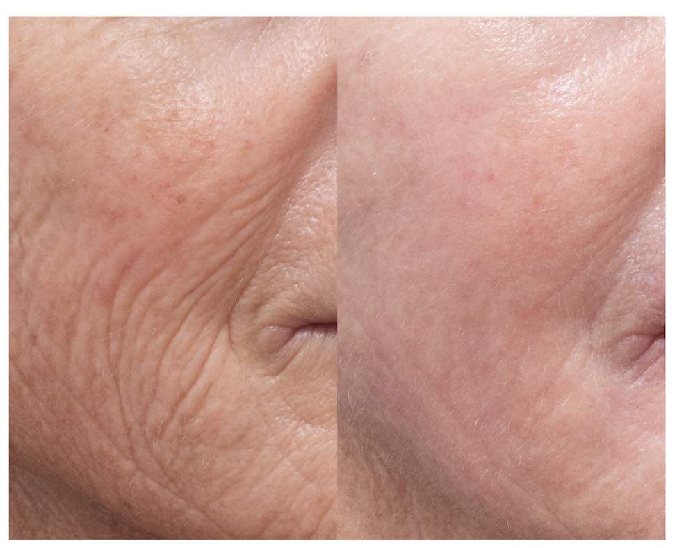 CO2 Laser Resurfacing Treatment in Melbourne