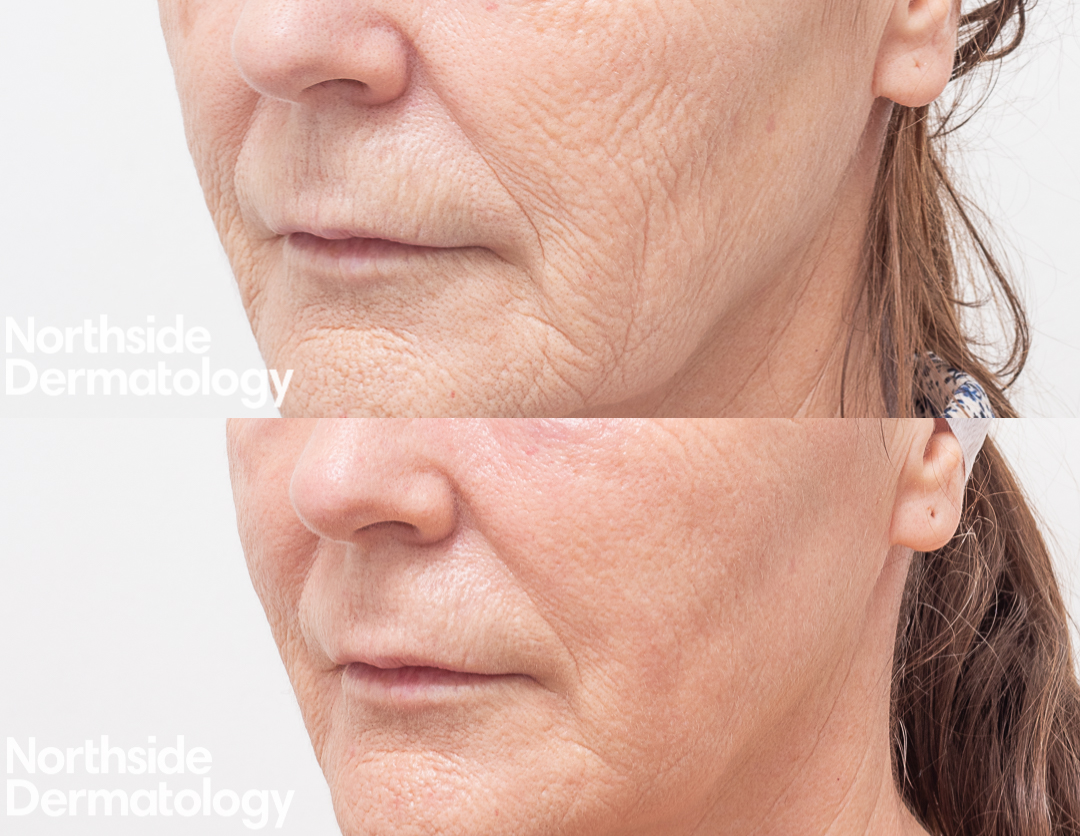 CO2 Laser Facial Rejuvenation: Fix Fine Lines, Wrinkles, Sun Damage &  Stretch Marks