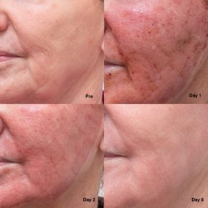CO2 Laser Resurfacing | Northside Dermatology