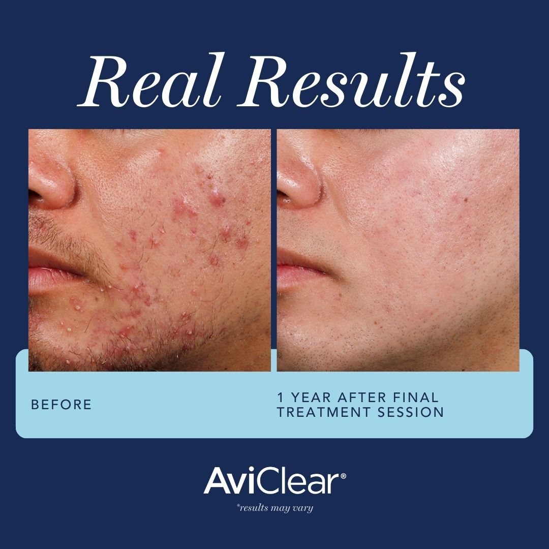 mild moderate severe acne pimples treatment with laser