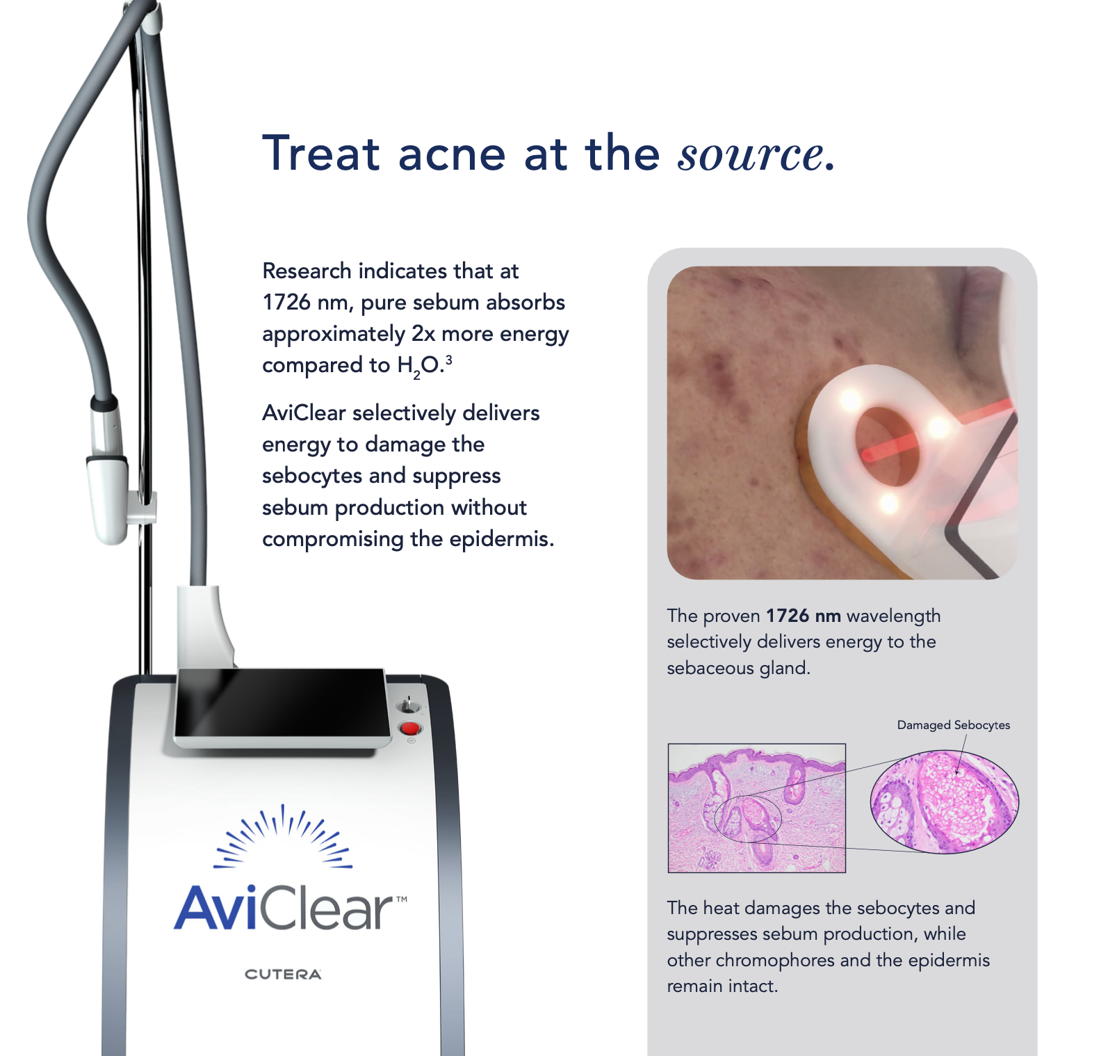 AviClear targeting at oil glands