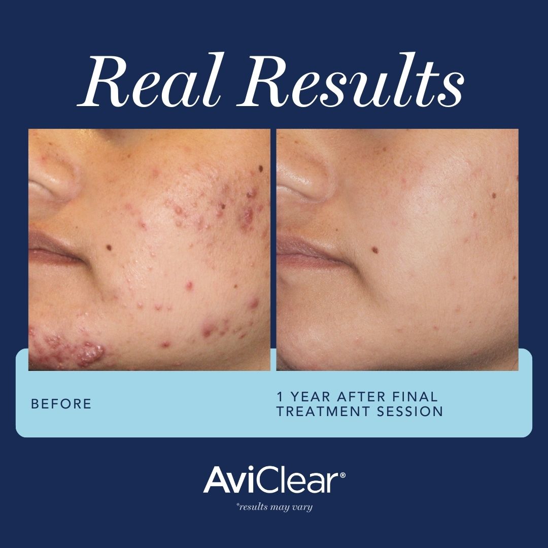 Scarring acne AviClear treatment 