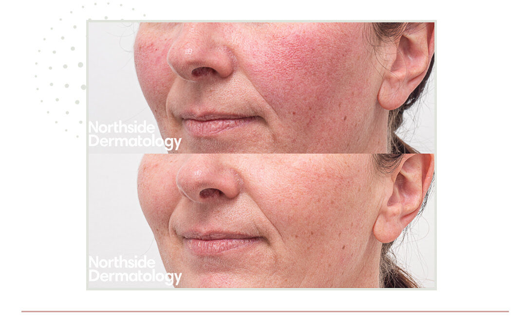 Before and after three sessions of vascular laser for rosacea - Northside Dermatology Melbourne