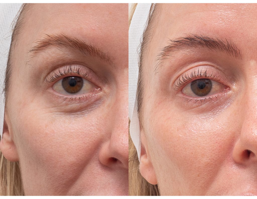 2465 SD 111188 CO2 EYE rejuvenation B and A photos