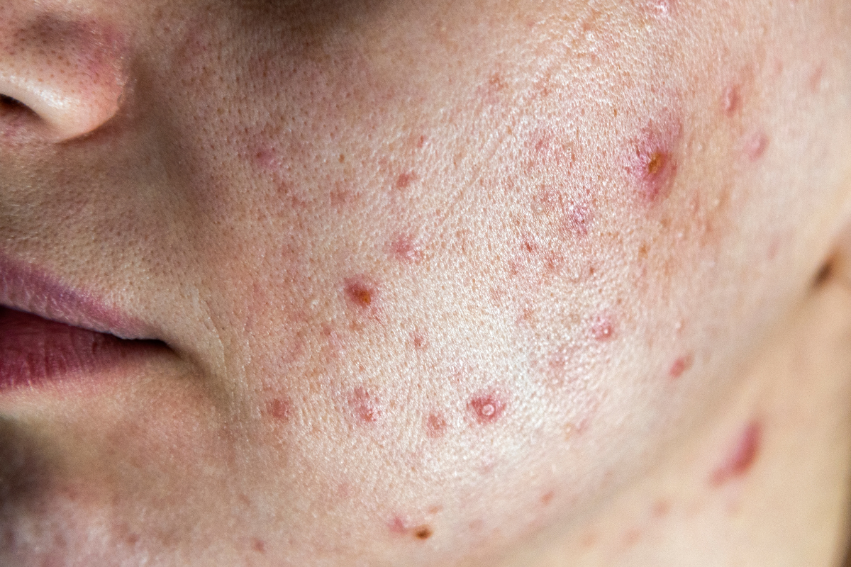 Acne Cheek